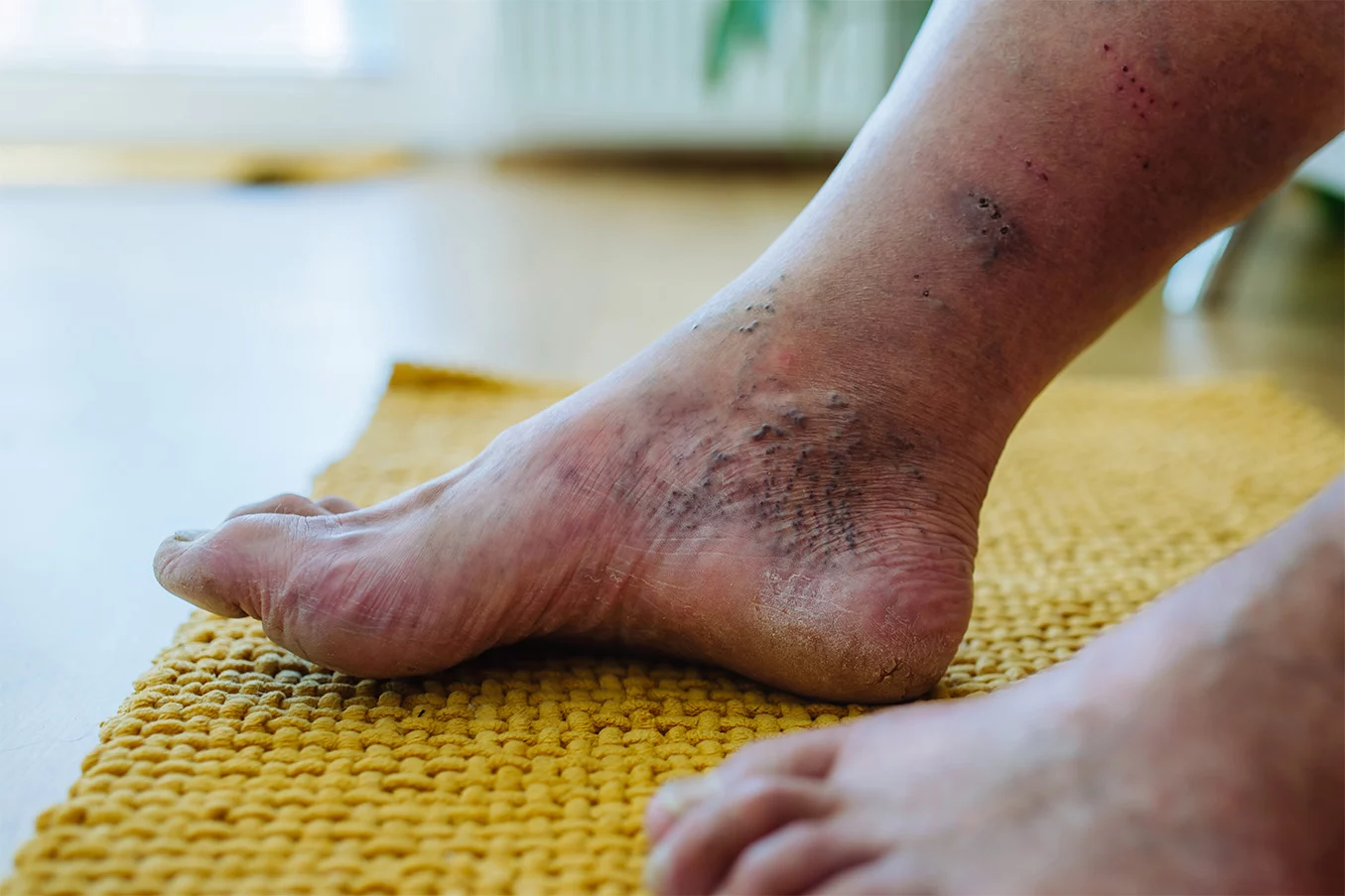 feet with diabetic foot envato2 schindlegger SCHINDLEGGER